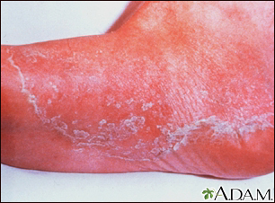 Tinea pedis (fungal foot infection)