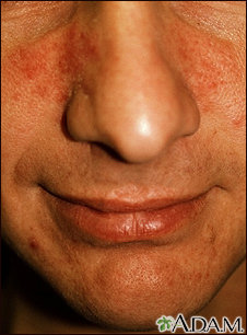 rosacea nose bumps