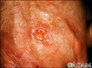 skin cancer types squamous cell carcinoma