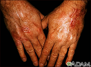 Skin cancer - squamous cell on the hands - Illustration Thumbnail
                      