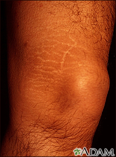 Striae on the leg - Illustration Thumbnail
              