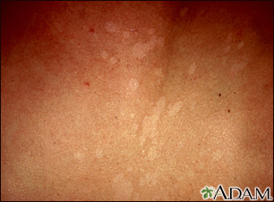 Tinea versicolor - close-up