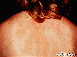 Tinea corporis lesions.  Download Scientific Diagram