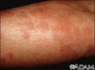 Hives (urticaria) on the arm - Illustration Thumbnail
              