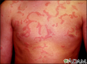 Hives (urticaria) on the chest - Illustration Thumbnail
                      