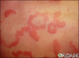 Hives (urticaria) - close-up - Illustration Thumbnail
                      