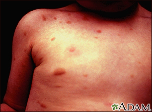 Urticaria pigmentosa on the chest