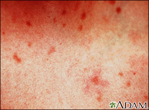 Urticaria pigmentosa Information