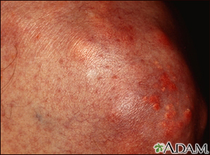 eruptive xanthomatosis face