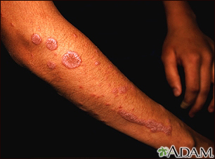 mayo clinic lichen planus