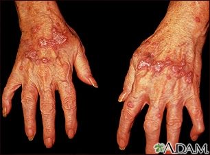 Lichen planus on the hands - Illustration Thumbnail
                      