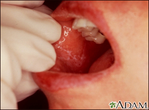 oral lichen planus cheek