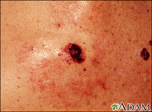 Skin cancer - close-up of level IV melanoma