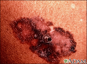 Skin cancer - melanoma superficial spreading - Illustration Thumbnail
                      