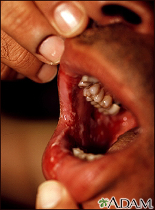 Pemphigus vulgaris - lesions in the mouth - Illustration Thumbnail
              