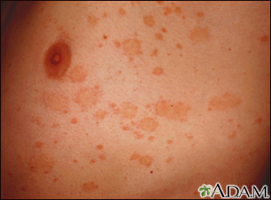 Pityriasis rosea Information