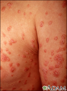 causes of rashes in adults