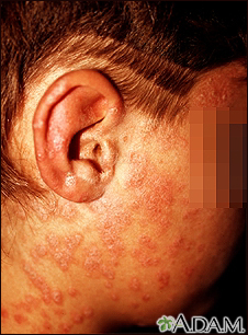 Types of Skin Rashes  Children's Skin Center PA