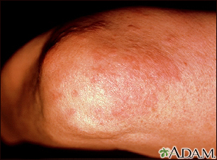Granuloma annulare on the elbow