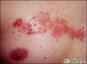 Herpes zoster (shingles) on the chest