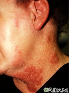 mild shingles on face