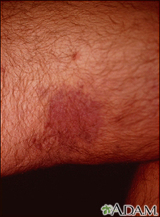 Kaposi sarcoma on the thigh - Illustration Thumbnail