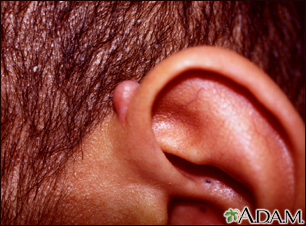 Keloid above the ear - Illustration Thumbnail
                      