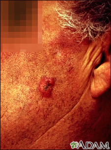 Squamous cell carcinoma - invasive - Illustration Thumbnail
                      