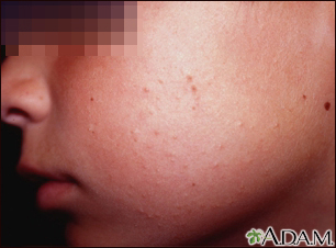 Is It Possible To Have a Malar Rash on One Side of the Face?