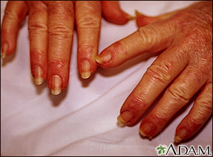 blood blister on finger nail cuticle