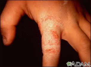 Medicina Clínica on X: Tinea manuum.