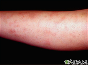 erythema nodosum legs