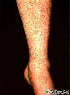 vascular rash