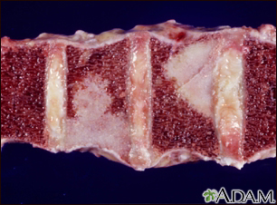 Spinal tumor