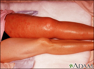 Deep vein thrombosis Information