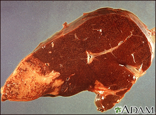 Hodgkin's disease - liver involvement - Illustration Thumbnail
              