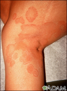 Ringworm - tinea corporis on the leg - Illustration Thumbnail
              