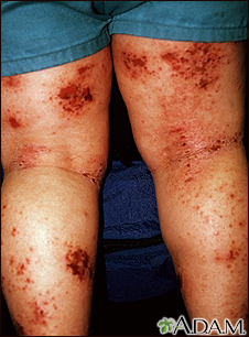 Atopic dermatitis Information