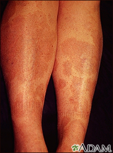 Granuloma annulare on the legs