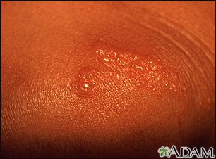 Small, Painful Blisters Erupt in Patient's Groin Area