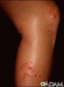 Contact dermatitis Information