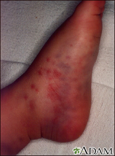 symptoms of petechiae