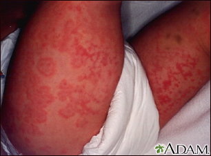 vascular rash