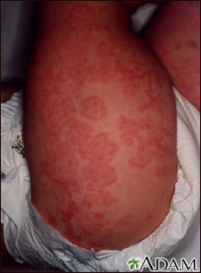 Purpura: Blood Spots, Thrombocytopenic, Symptoms & Causes