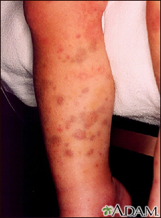 causes of rash purple