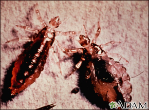 Lice, body with stool (Pediculus humanus) - Illustration Thumbnail              