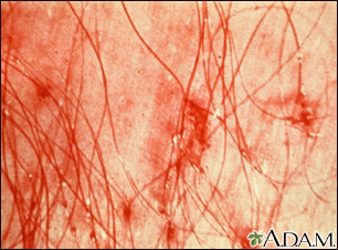 Trichomycosis pubis causes symptoms dignosis  treatment