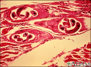 Trichinella spiralis in human muscle - Illustration Thumbnail
              