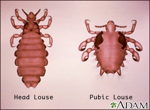 pubic lice treatment