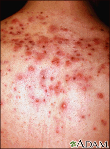 Acne - close-up of cysts on the back - Illustration Thumbnail
              